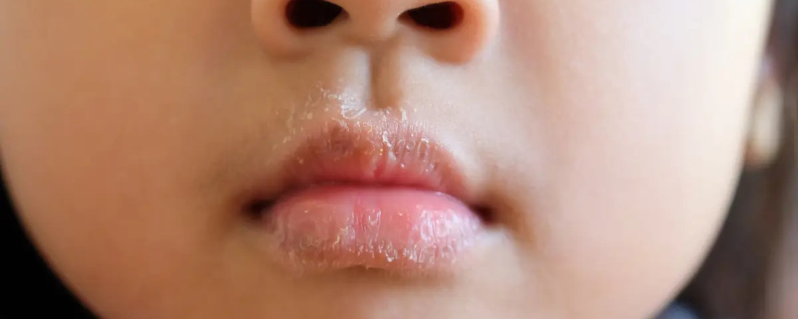 Почему трескаются губы и что с этим делать