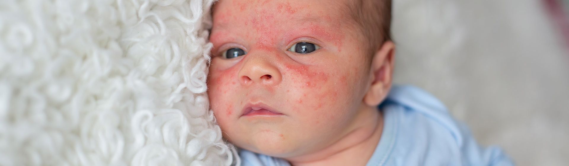 Красные щеки и температура у ребенка: причины и последствия